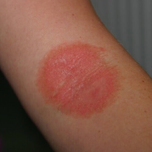 Dermatophytosis in a human