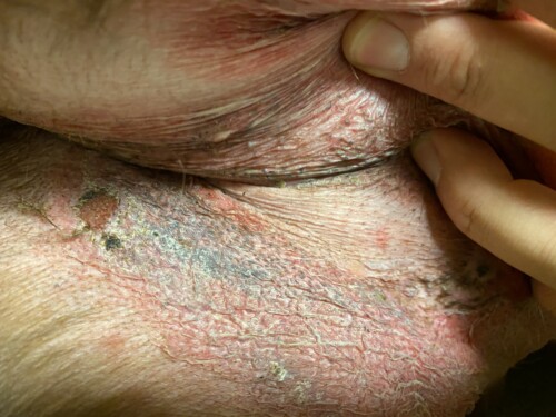 Adverse Topical Steroid Reaction in a 4y FS Chocolate Lab