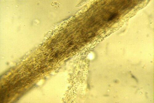 dermatophyte infected hair Hair shaft infected by a dermatophyte on direct examination