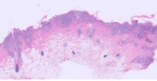A Case of Cutaneous small cell indolent T-cell lymphoma in a 15-Year-Old Cat