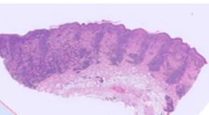 A Case of Cutaneous small cell indolent T-cell lymphoma in a 15-Year-Old Cat