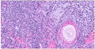 A Case of Cutaneous small cell indolent T-cell lymphoma in a 15-Year-Old Cat